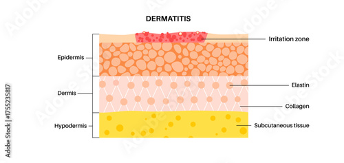 Dermatitis skin disease