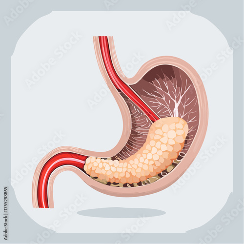 Illustration of a stomach with a tumor or growth inside, showing the esophagus and intestines.