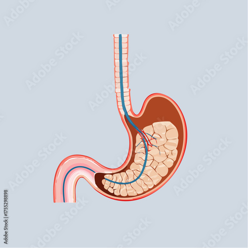 Medical illustration of an endoscopic procedure showing a tube inserted into the human stomach and duodenum.