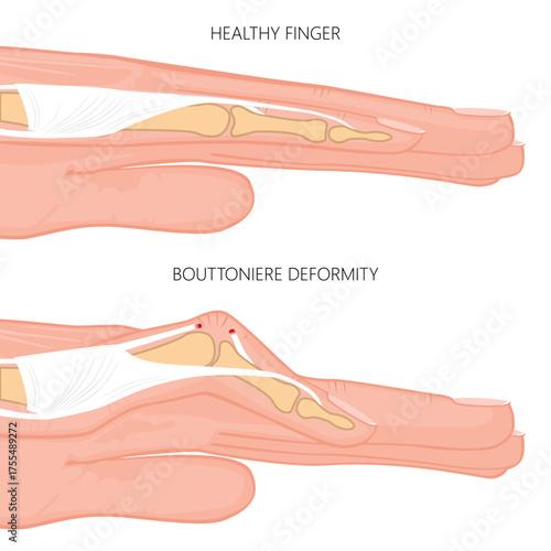 Bouttoniere little finger deformity. Vector illustranion
