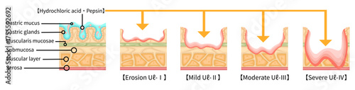 胃潰瘍　重症度　イラスト　英語