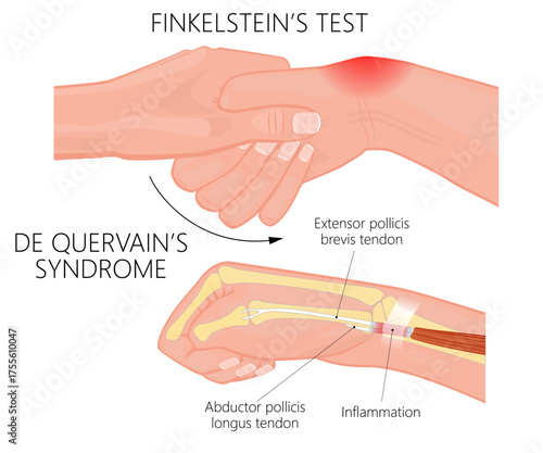 Finklestein test. Quervain syndrome. Vector illustranion