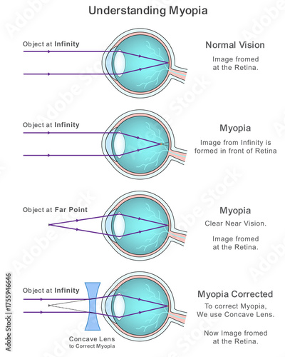 Medical infographic explaining myopia, normal vision, and corrective measures with concave lenses. Ideal for eye health education and visual clarity topics. Ophthalmology content nearsightedness.