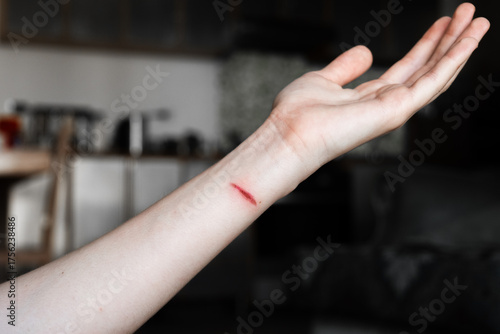 A close-up of a pale arm with a fresh burn mark. The skin shows a red line indicating injury. The background is blurred.