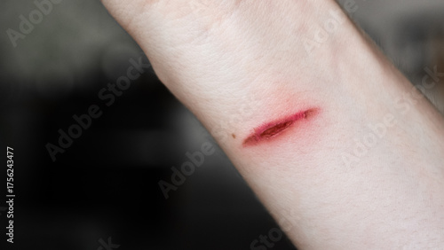 A close-up of a pale arm with a fresh burn mark. The skin shows a red line indicating injury. The background is blurred.