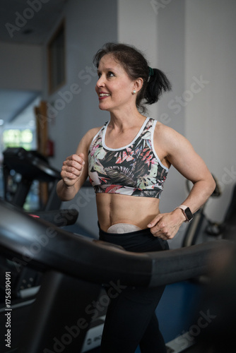 Woman with ostomy bag exercising on treadmill