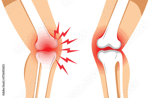 Illustration of knee joint pain and inflammation with lightning bolt symbols