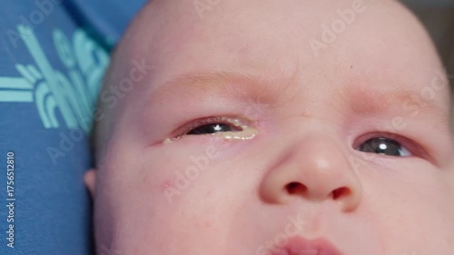 Baby eyes with eye mucus in selective focus. Disease tear ducts tons of newborns close up. Nasolacrimal duct obstruction in baby it is a blockage of the lacrimal drainage system. 