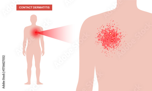 Dermatitis skin disease