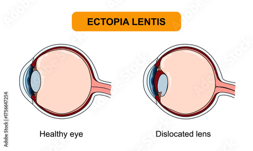 Ectopia lentis illustration, torn zonular fibers. Healthy eyes and vision disorders, genetic diseases. Ophthalmology appointment. Vector illustration of eye health, poster for medical and education