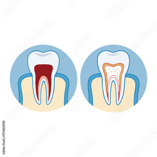 Illustration showing a healthy tooth and a tooth with pulpitis, displayed in a circular frame on a white background.
