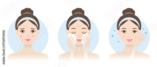 Cute woman treating acne with cleanser and steps skincare routine set vector illustration. Acne and skincare solution series, before and after cleansing face. Beauty routine and self care concept.