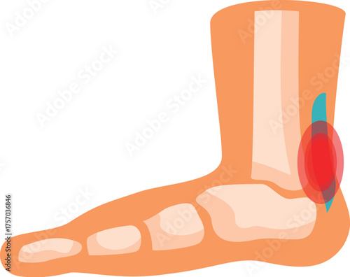 Medical illustration showing a lateral ankle sprain with ligament rupture and swelling