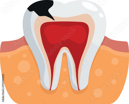 Cross section of molar showing pulpitis inside gums with black decay on surface, emphasizing dental health and care
