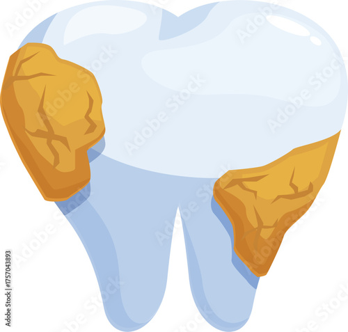 Dental tartar and plaque accumulating on a tooth, potentially leading to cavities and gum disease