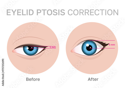 Illustration of eyelid ptosis correction showing before and after transformation.Upper blepharoplasty.Perfect for beauty and medical content.