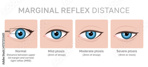 Illustration of Ptosis Severity: From Normal to Severe Eyelid Droop. Can be used for beauty and medical content.