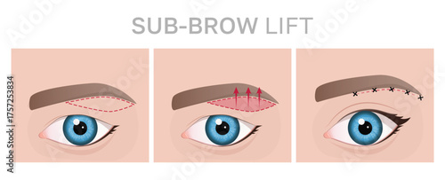 Step-by-Step Guide to Sub-Brow Lift Procedure. Illustration can be used for beauty and medical content.