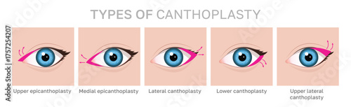 Eye Surgery Techniques: Exploring the Different Types of Canthoplasty. Illustration can be used for beauty and medical content.