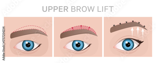 Step-by-Step Guide to Upper Brow Lift Procedure. Illustration can be used for beauty and medical content.