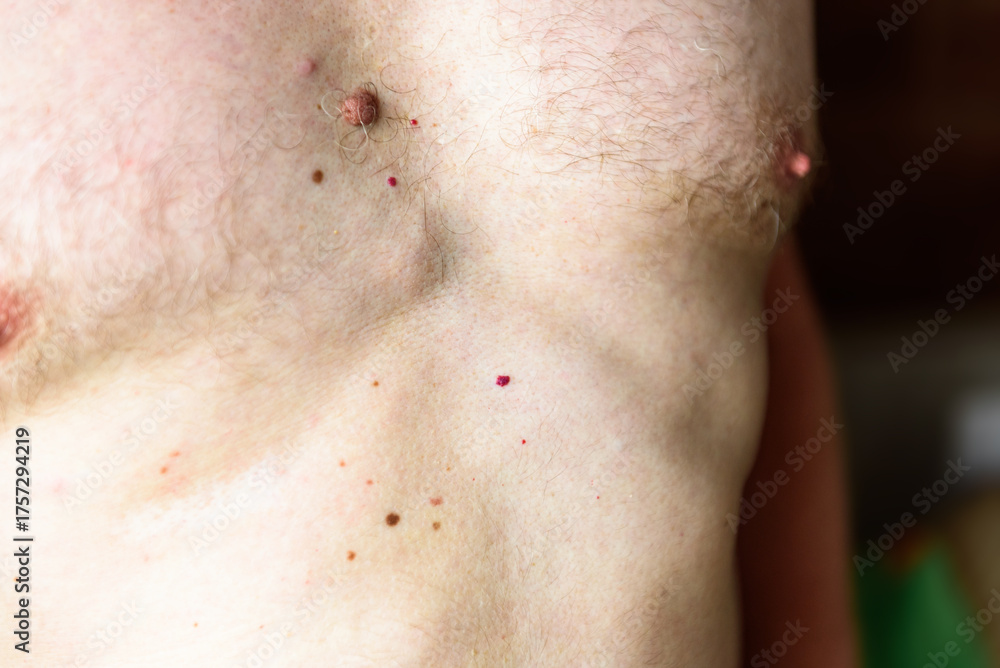 Fototapeta premium Lipomatosis or Dercum's disease (neurolipomatosis) on the man's abdomen. Foci of overgrown fatty tissue.