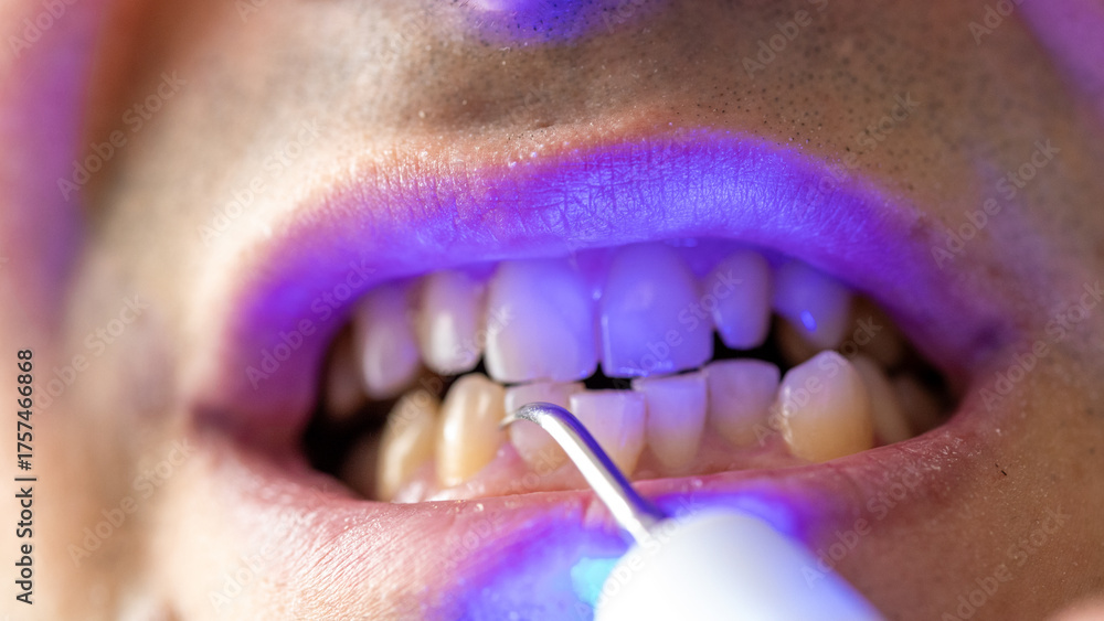 Naklejka premium Close-Up of a Dental Hygienist Cleaning Teeth with a Mini Tartar Removal Device 