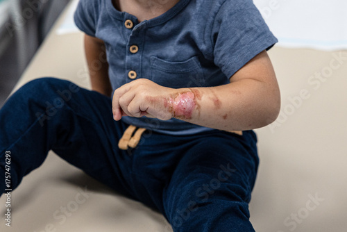 Poparzona ręka u dziecka