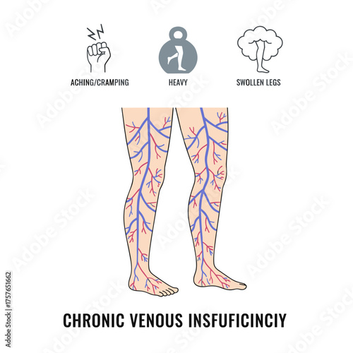 Symptoms include chronic venous insufficiency in the lower limbs, leg aching or cramping, a sensation of heaviness, varicose veins, dilated capillaries or spider veins, and swelling of the legs