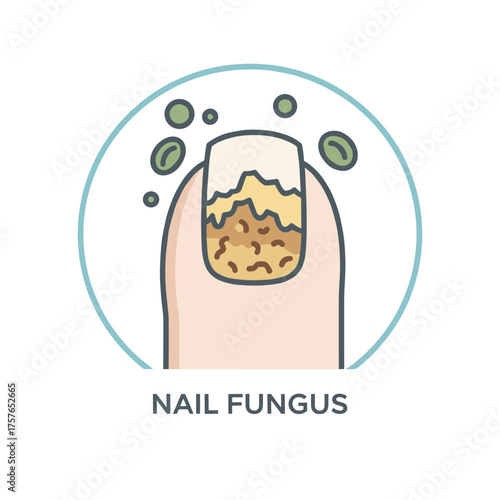 Illustration of a fungal nail infection in vector line art, representing a nail disease icon for podology and dermatology, covering fungal infection, psoriasis, nail care, cosmetology, medicine, and