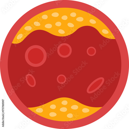 Illustration of Artery Clogged with Cholesterol
