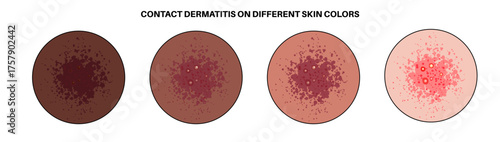 Dermatitis skin disease