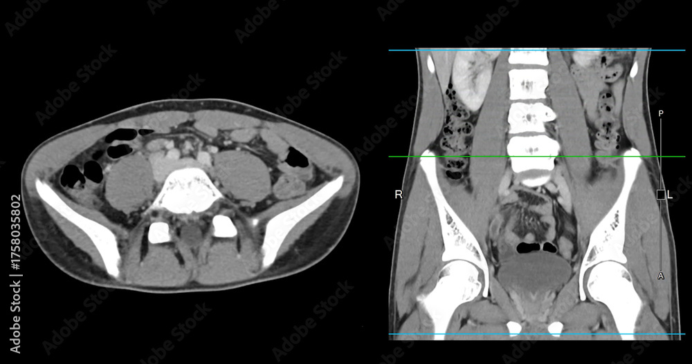 Φωτογραφία High-resolution CT scan Lower abdomen showing a normal lower abdomen for diagnostic reference,and healthcare presentations