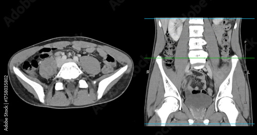  High-resolution CT scan Lower abdomen showing a normal lower abdomen for diagnostic reference,and healthcare presentations.Clear anatomical highlight healthy abdominal structure.