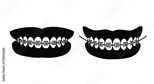 Black and white illustration of teeth with braces open and closed mouth