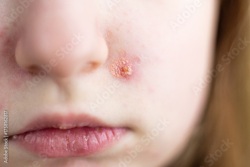 Child having impetigo skin infection chicken pox on face