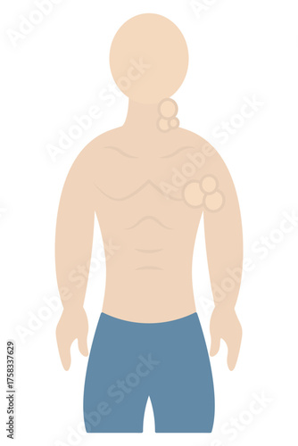 Enlarged lymph nodes. Color vector illustration. The patient has swollen lymph nodes in the neck and armpits. A symptom of problems in the body. Isolated background. Flat style. Medical theme.