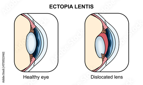 Ectopia lentis illustration, torn zonular fibers. Healthy eyes and vision disorders, genetic diseases. Ophthalmology appointment. Vector illustration of eye health, poster for medical and education