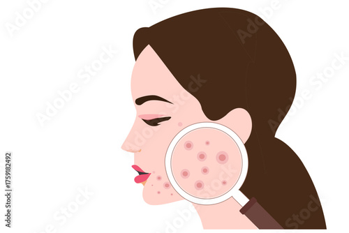 Young woman face with skin acne, pimples, blackheads vector illustration. Acne skin face problem concept