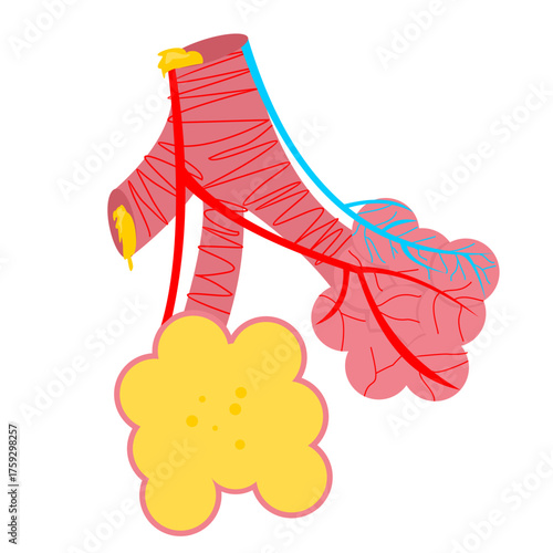 Illustration of bronchi and alveoli filled with mucus, showing symptoms of pneumonia or respiratory infection, flat art design style.
