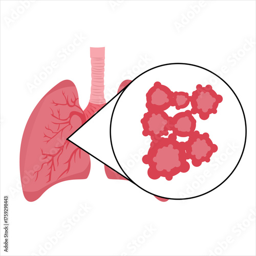 Infected lungs with visible spots and patches, zoomed in to show signs of disease or lung infection, flat art design style.
