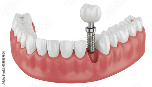 Dental Implant Model Isolated On Transparent Background