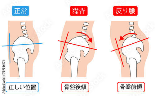 正しい姿勢と猫背と反り腰　背骨と骨盤
