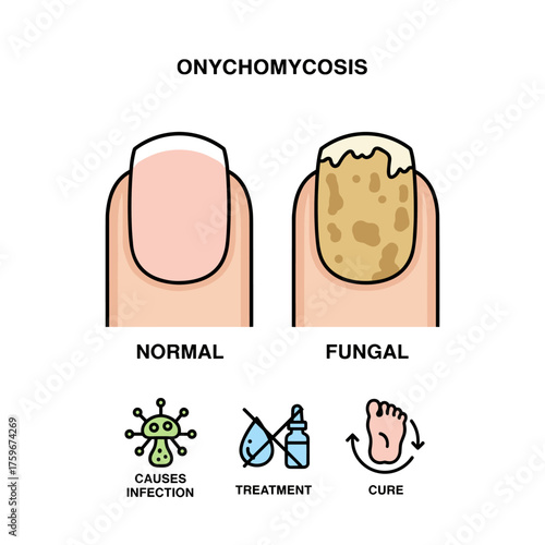 Illustration of a fungal nail, showing the nail before and after infection, with both fungal and normal nail vectors, depicting nail diseases such as onychomycosis, its causes, and treatment icon