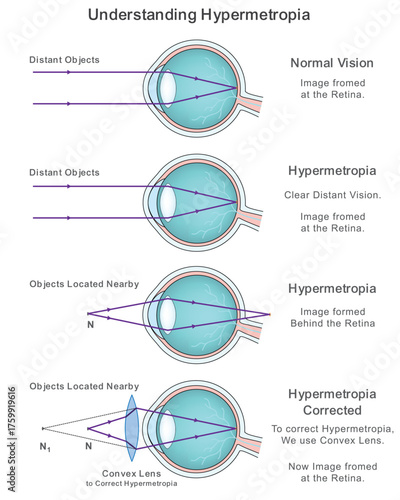 Illustration showing Hypermetropia or farsightedness where distant objects appear clear but nearby objects are blurred, explained with human eye structure and lens diagram.