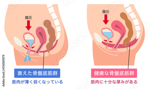 衰えた骨盤底筋群と健康な骨盤底筋群