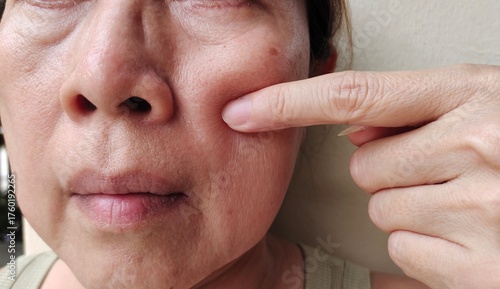 portrait the fingers holding the cheek, wrinkle and Flabby skin beside the mouth, dark spots and blemish on the face, health care and beauty concept.