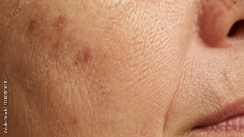 Close Up of Woman's Face Showing Signs of Melasma Pigmentation and Aging on Skin with Fine Lines Wrinkles and Uneven Texture Around Nose and Mouth Area Showing Dermatology Concern