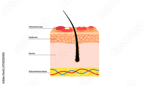 Dermatitis skin disease