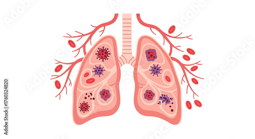 Human Lungs Infected with Virus Medical Illustration