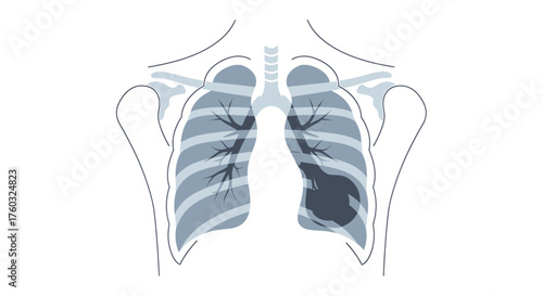 Lung Cancer Anatomy Illustration Visualizing Tumor Growth in the Respiratory System